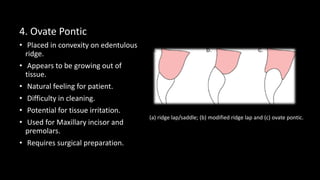 bridge and pontic design lecture | PPT