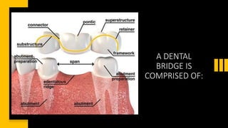A DENTAL
BRIDGE IS
COMPRISED OF:
 