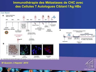 Immunothérapie des Métastases de CHC avec
des Cellules T Autologues Ciblant l’Ag HBs
W Quasim J Hepatol 2015
 