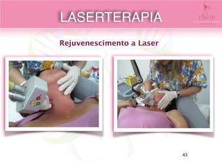 Rejuvenescimento a Laser
LASERTERAPIA
43
 