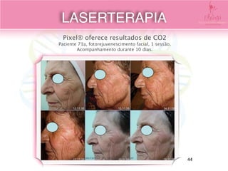 Pixel® oferece resultados de CO2 
Paciente 71a, fotorejuvenescimento facial, 1 sessão. 
Acompanhamento durante 10 dias.
Foto Cortesia : Dr. Tania Meneghel, Brazil 
LASERTERAPIA
44
 