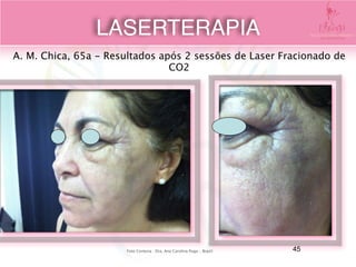A. M. Chica, 65a - Resultados após 2 sessões de Laser Fracionado de
CO2 
Foto Cortesia : Dra. Ana Carolina Puga - Brazil 
LASERTERAPIA
45
 