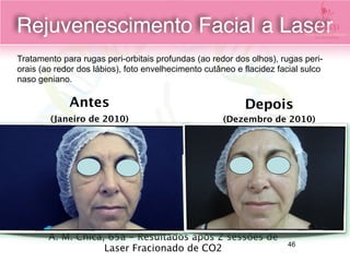 A. M. Chica, 65a - Resultados após 2 sessões de
Laser Fracionado de CO2 
Antes
(Janeiro de 2010)
Depois
(Dezembro de 2010)
Tratamento para rugas peri-orbitais profundas (ao redor dos olhos), rugas peri-
orais (ao redor dos lábios), foto envelhecimento cutâneo e flacidez facial sulco
naso geniano.
Rejuvenescimento Facial a Laser
46
 