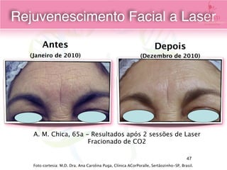 A. M. Chica, 65a - Resultados após 2 sessões de Laser
Fracionado de CO2
Antes
(Janeiro de 2010)
Depois
(Dezembro de 2010)
Foto cortesia: M.D. Dra. Ana Carolina Puga, Clínica ACorPoralle, Sertãozinho-SP, Brasil.
Rejuvenescimento Facial a Laser
47
 