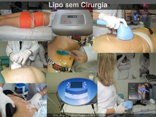Lipo sem Cirurgia
Dra. Ana Carolina Puga – CRBM: 5589
49
 
