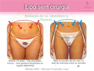 Mulher 25 anos – faz atividades
físicas – com gordura localizada na
região abdominal
Após 8 sessões de UC com 15
dias de intervalo entre as sessões
Redução de GL Abdômen e
Flancos
Método: HIFU – Ultrasom Focalizado, Laser
Lipo sem cirurgia
50
 