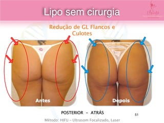 POSTERIOR - ATRÁS
Antes Depois
Redução de GL Flancos e
Culotes
Método: HIFU – Ultrasom Focalizado, Laser
Lipo sem cirurgia
51
 