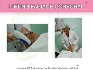 Foto cortesia: M.D. Dra. Ana Carolina Puga, Clínica ACorPoralle, Sertãozinho-SP, Brasil.
LIFTING FACIAL E CORPORAL
55
 
