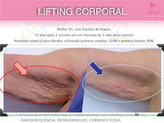 Foto cortesia: Hernán Emilio Romero Duque, M.D. Unidade Dermatologia - Laser dermatológico, Pereira, Colombia
Mulher 81, com ﬂacidez de braços.
15 dias após 2 sessões em um intervalo de 1 mês entre sessões
Protocolo especial para ﬂacidez utilizando ponteira unipolar 150W e ponteira bipolar 80W.
RADIOFREQUÊNCIA, INFRAVERMELHO, CORRENTE RUSSA
LIFTING CORPORAL
56
 