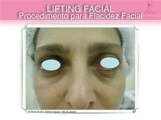 Cortesia da Dra. Adriana Aquino - Rio de Janeiro
LIFTING FACIAL 
Procedimento para Flacidez Facial
57
 