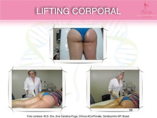 Foto cortesia: M.D. Dra. Ana Carolina Puga, Clínica ACorPoralle, Sertãozinho-SP, Brasil.
LIFTING CORPORAL
58
 