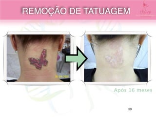 Após 16 meses
REMOÇÃO DE TATUAGEM
59
 