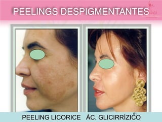 PEELING LICORICE ÁC. GLICIRRÍZICO
PEELINGS DESPIGMENTANTES
61
 