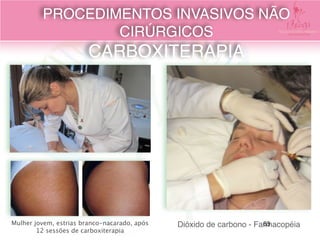 Mulher jovem, estrias branco-nacarado, após
12 sessões de carboxiterapia
Dióxido de carbono - Farmacopéia
PROCEDIMENTOS INVASIVOS NÃO
CIRÚRGICOS 
CARBOXITERAPIA
63
 