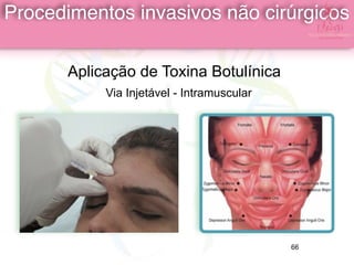 Aplicação de Toxina Botulínica
Via Injetável - Intramuscular
Procedimentos invasivos não cirúrgicos
66
 