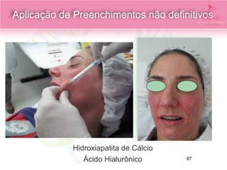 Aplicação de Preenchimentos não definitivos
Hidroxiapatita de Cálcio
Ácido Hialurônico 67
 