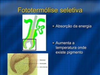 Fototermólise seletiva
Absorção da energia
Aumenta a
temperatura onde
existe pigmento
 