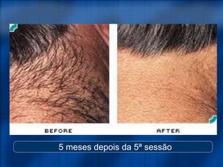 5 meses depois da 5ª sessão
 