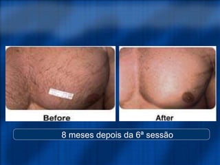 8 meses depois da 6ª sessão
 