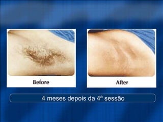 4 meses depois da 4ª sessão
 