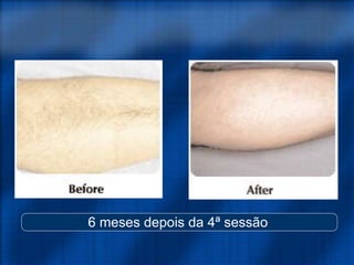 6 meses depois da 4ª sessão
 