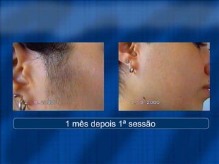 1 mês depois 1ª sessão
 