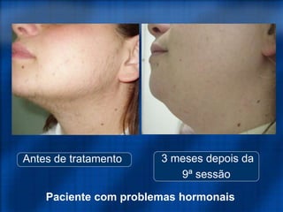 Paciente com problemas hormonais
Antes de tratamento 3 meses depois da
9ª sessão
 