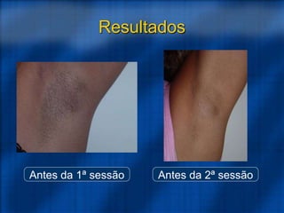 Antes da 1ª sessão Antes da 2ª sessão
Resultados
 