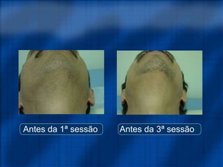 Antes da 1ª sessão Antes da 3ª sessão
 