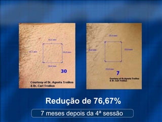 7 meses depois da 4ª sessão
Redução de 76,67%
 