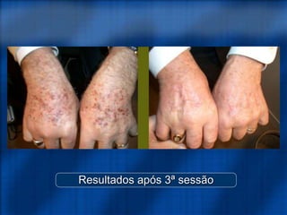 Resultados após 3ª sessão
 