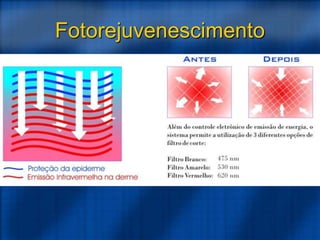 Fotorejuvenescimento
 