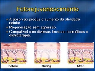 Fotorejuvenescimento
A absorção produz o aumento da atividade
celular.
Regeneração sem agressão.
Compatível com diversas técnicas cosméticas e
eletroterapia.
 