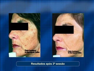 Resultados após 3ª sessão
 