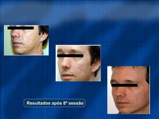 Resultados após 8ª sessão
 