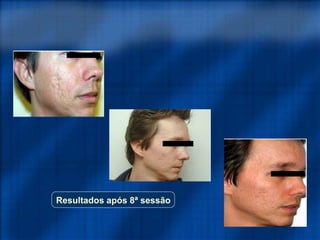 Resultados após 8ª sessão
 