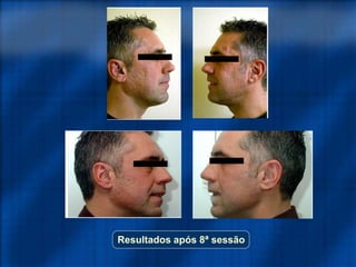 Resultados após 8ª sessão
 