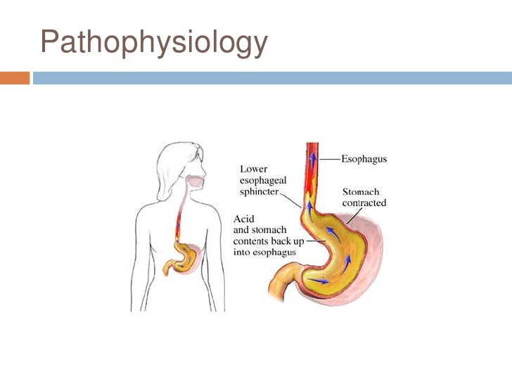 Etiology of gerd