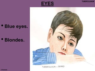 © Subrata
EYES
•Blue eyes.
•Blondes.
TUBERCULINUM
 