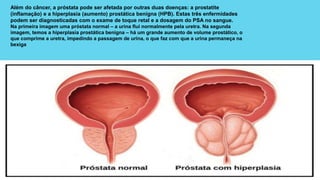 Além do câncer, a próstata pode ser afetada por outras duas doenças: a prostatite
(inflamação) e a hiperplasia (aumento) prostática benigna (HPB). Estas três enfermidades
podem ser diagnosticadas com o exame de toque retal e a dosagem do PSA no sangue.
Na primeira imagem uma próstata normal – a urina flui normalmente pela uretra. Na segunda
imagem, temos a hiperplasia prostática benigna – há um grande aumento de volume prostático, o
que comprime a uretra, impedindo a passagem de urina, o que faz com que a urina permaneça na
bexiga
 