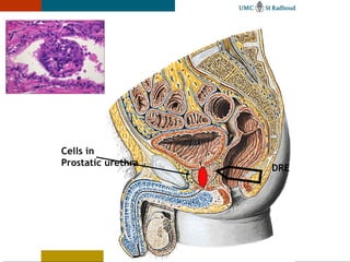Cells in
Prostatic urethra
                    DRE
 