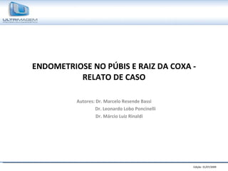 ENDOMETRIOSE NO PÚBIS E RAIZ DA COXA - RELATO DE CASO Autores: Dr. Marcelo Resende Bassi Dr. Leonardo Lobo Poncinelli Dr. Márcio Luiz Rinaldi 