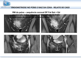 ENDOMETRIOSE NO PÚBIS E RAIZ DA COXA - RELATO DE CASO RM da pelve – sequência coronal DP Fat Sat + Gd mostrando realce intenso e heterogêneo da lesão pelo meio de contraste paramagnético. 