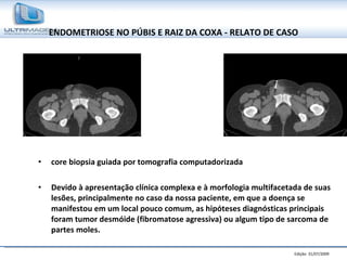 ENDOMETRIOSE NO PÚBIS E RAIZ DA COXA - RELATO DE CASO core biopsia guiada por tomografia computadorizada Devido à apresentação clínica complexa e à morfologia multifacetada de suas lesões, principalmente no caso da nossa paciente, em que a doença se manifestou em um local pouco comum, as hipóteses diagnósticas principais foram tumor desmóide (fibromatose agressiva) ou algum tipo de sarcoma de partes moles. 