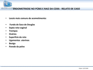 ENDOMETRIOSE NO PÚBIS E RAIZ DA COXA - RELATO DE CASO Locais mais comuns de acometimento: Fundo de Saco de Douglas  Septo reto-vaginal  Trompas Ovários Superfície do reto  Ligamentos  uterinos Bexiga  Parede da pelve 