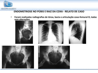 ENDOMETRIOSE NO PÚBIS E RAIZ DA COXA - RELATO DE CASO Foram realizadas radiografias de tórax, bacia e articulação coxo-femural D, todas sem alterações. 