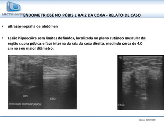 ENDOMETRIOSE NO PÚBIS E RAIZ DA COXA - RELATO DE CASO ultrassonografia de abdômen Lesão hipoecóica sem limites definidos, localizada no plano cutâneo muscular da região supra púbica e face interna da raiz da coxa direita, medindo cerca de 4,0 cm no seu maior diâmetro. 