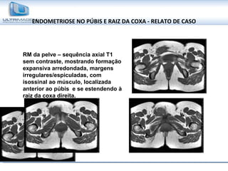 ENDOMETRIOSE NO PÚBIS E RAIZ DA COXA - RELATO DE CASO RM da pelve – sequência axial T1 sem contraste, mostrando formação expansiva arredondada, margens irregulares/espiculadas, com isossinal ao músculo, localizada anterior ao púbis  e se estendendo à raiz da coxa direita. 