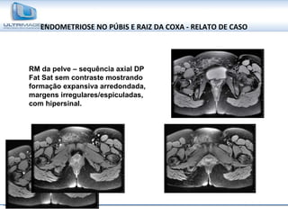 ENDOMETRIOSE NO PÚBIS E RAIZ DA COXA - RELATO DE CASO RM da pelve – sequência axial DP Fat Sat sem contraste mostrando formação expansiva arredondada, margens irregulares/espiculadas, com hipersinal. 
