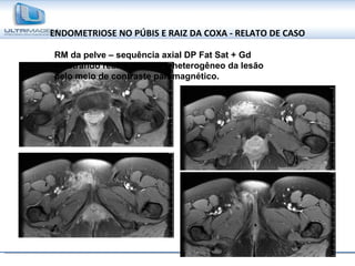 ENDOMETRIOSE NO PÚBIS E RAIZ DA COXA - RELATO DE CASO RM da pelve – sequência axial DP Fat Sat + Gd mostrando realce intenso e heterogêneo da lesão pelo meio de contraste paramagnético. 